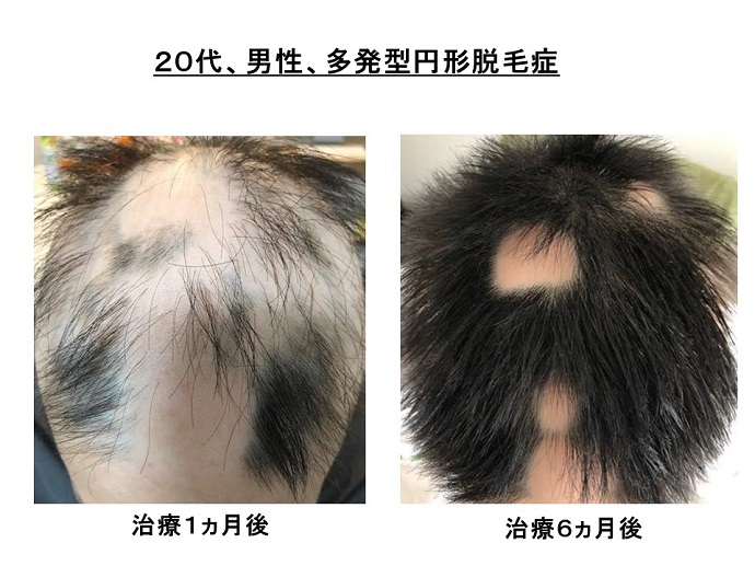 円形脱毛症　病院